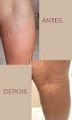 Resultado antes e depois de tratamento vascular
