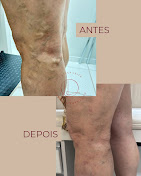 Resultado antes e depois de varizes
