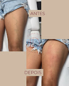 Resultado antes e depois nas pernas