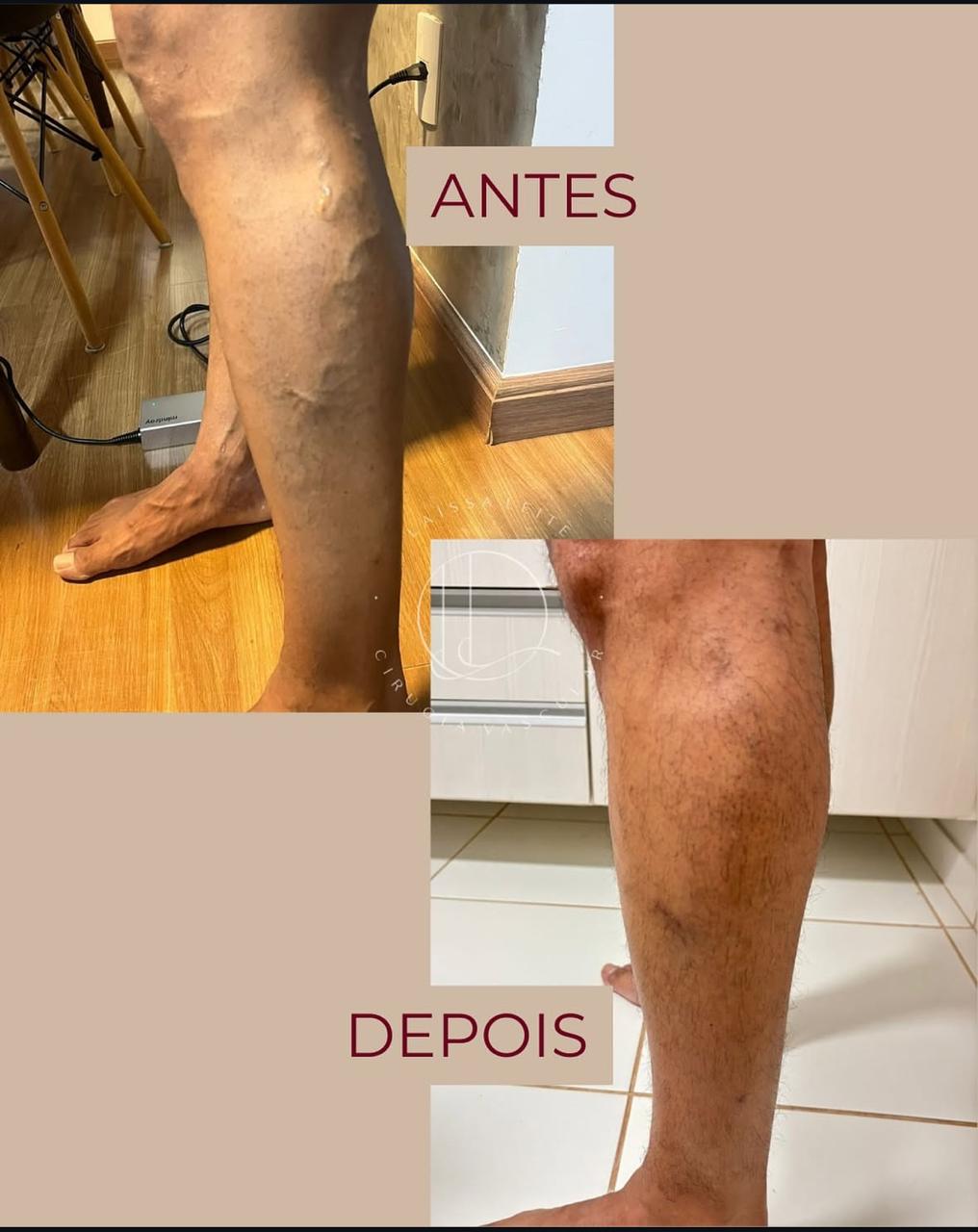 Resultado de tratamento vascular em perna