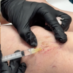 Escleroterapia: Elimine os pequenos vasinhos com um tratamento rápido e eficaz que melhora a estética e reduz desconfortos